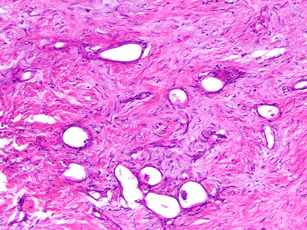 Post therapy dystrophic tumor glands