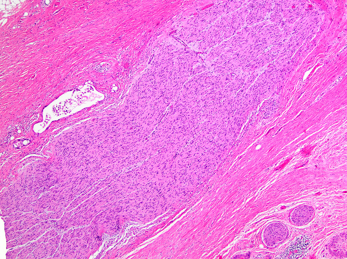 Perineural residual tumor glands