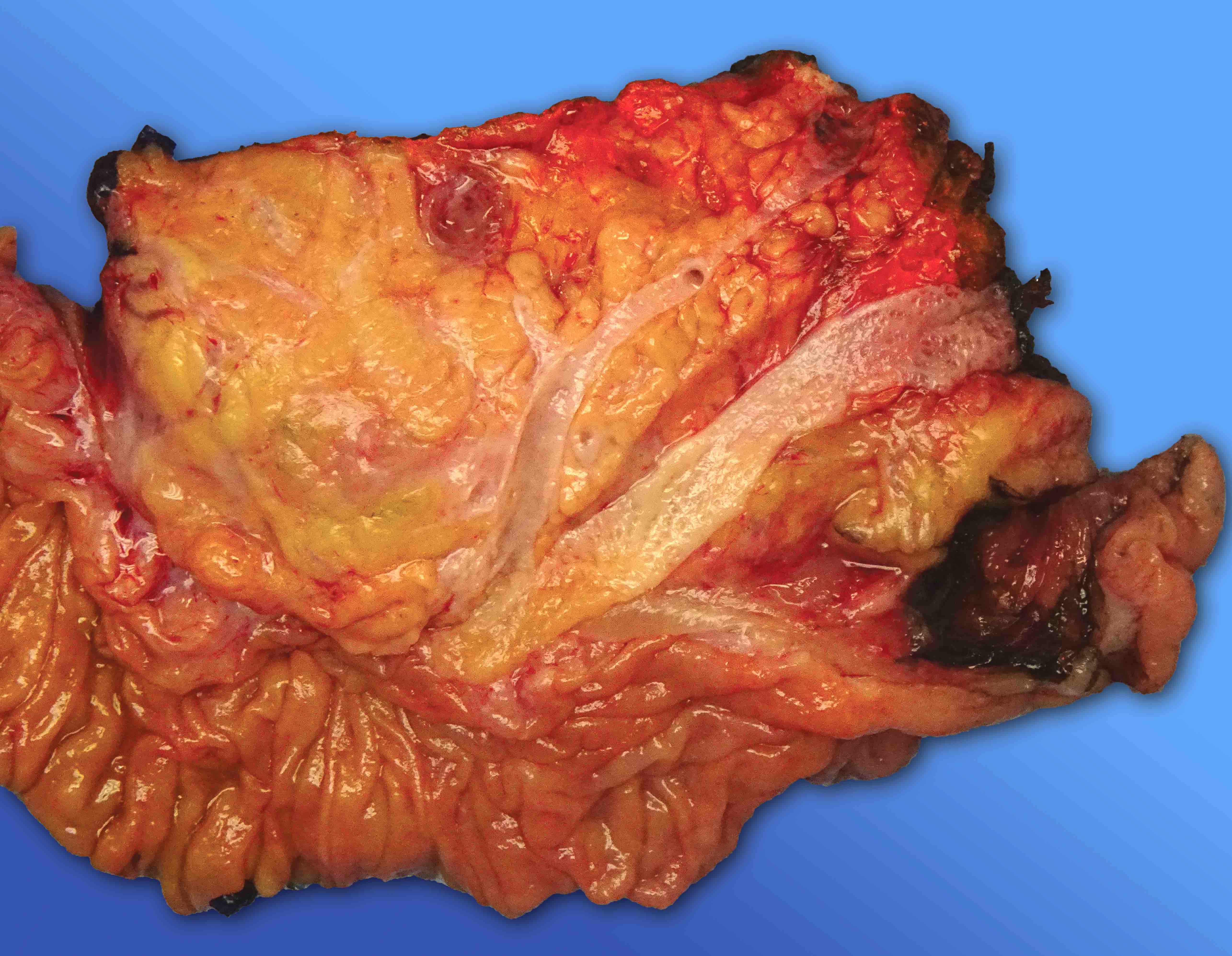 Cut surface of the pancreatic head