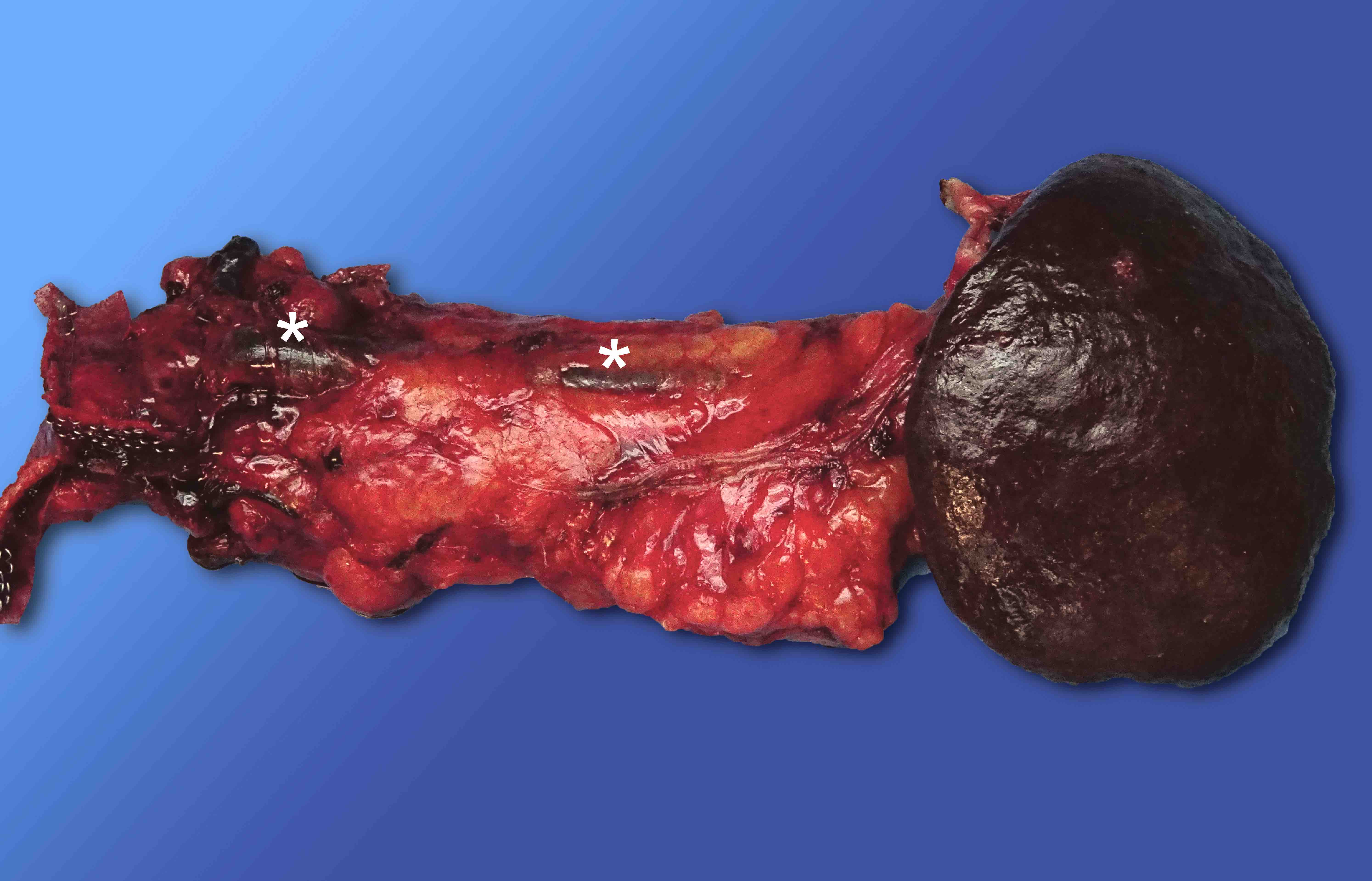 Anterior surface of distal pancreatectomy