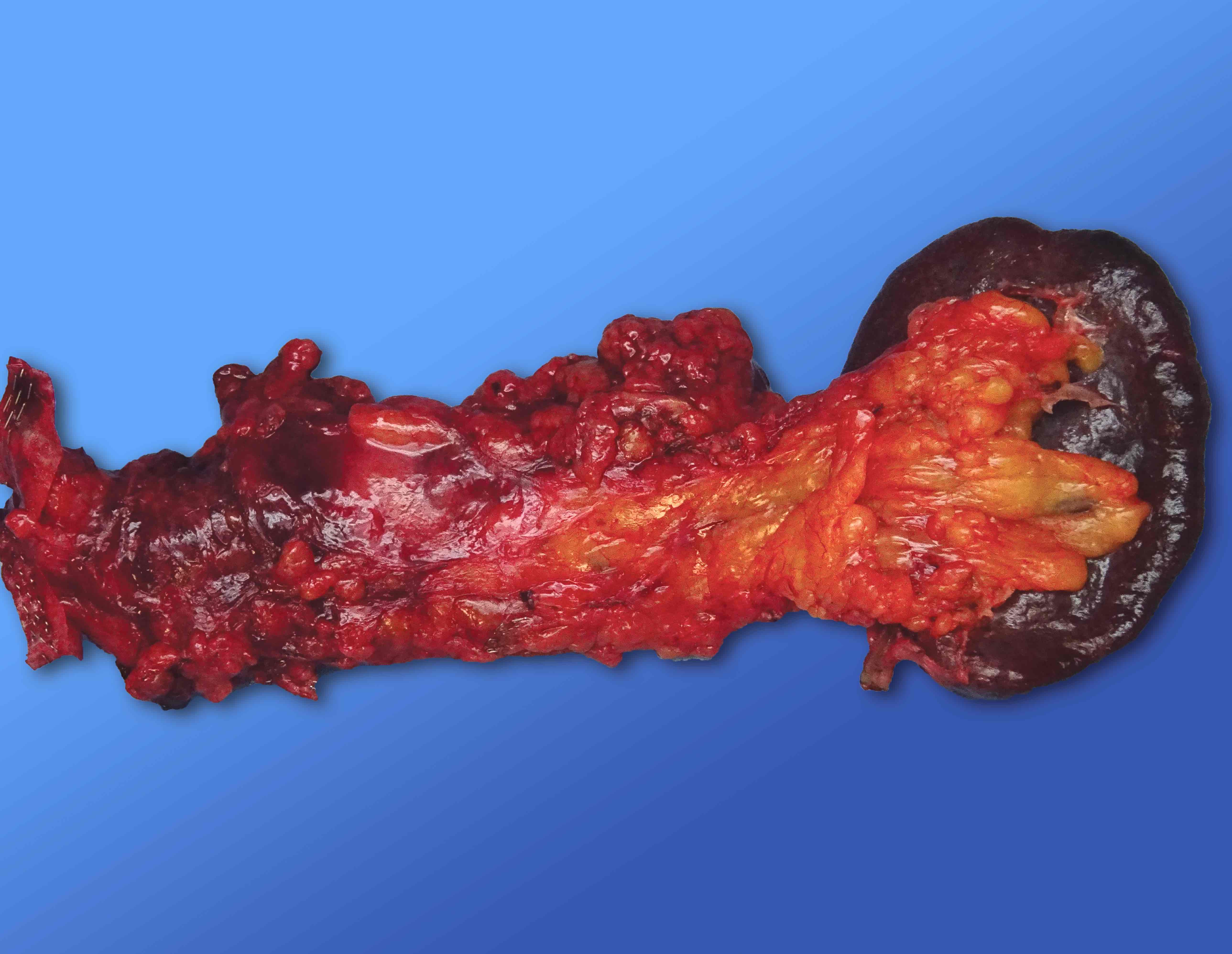 Posterior surface of distal pancreatectomy