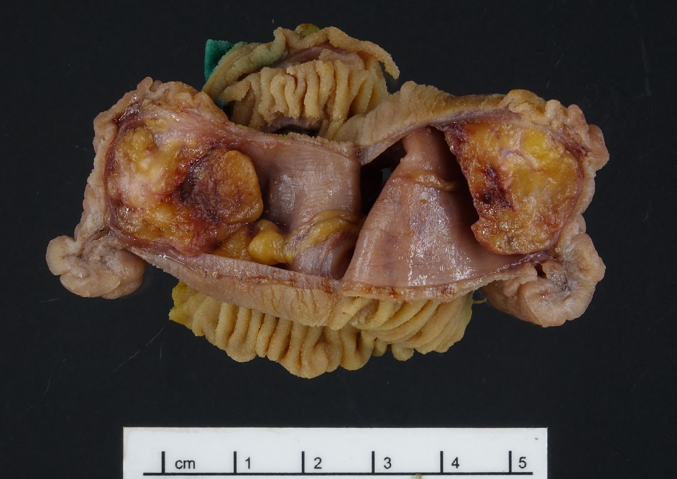 Heterotopic pancreas in Meckel Diverticulum