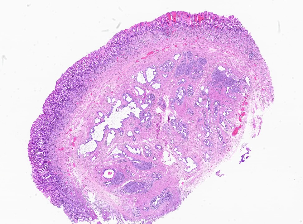 Heterotopic pancreas predominantly ducts