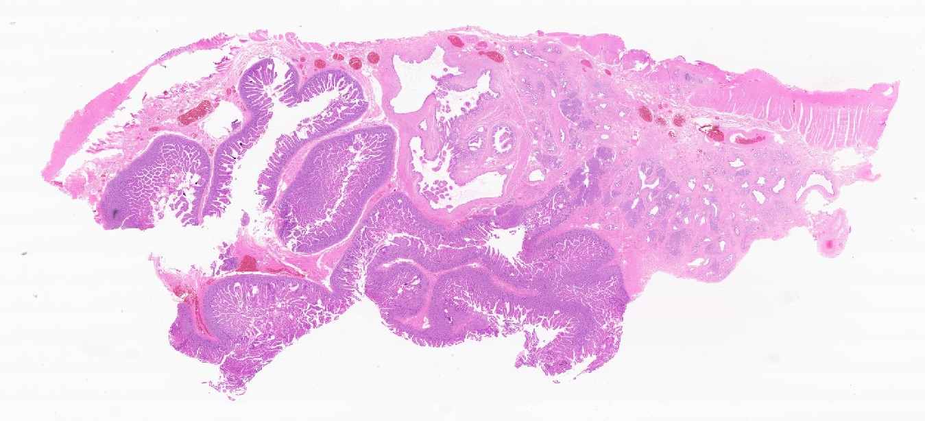 Intraductal papillary mucinous neoplasm (IPMN)