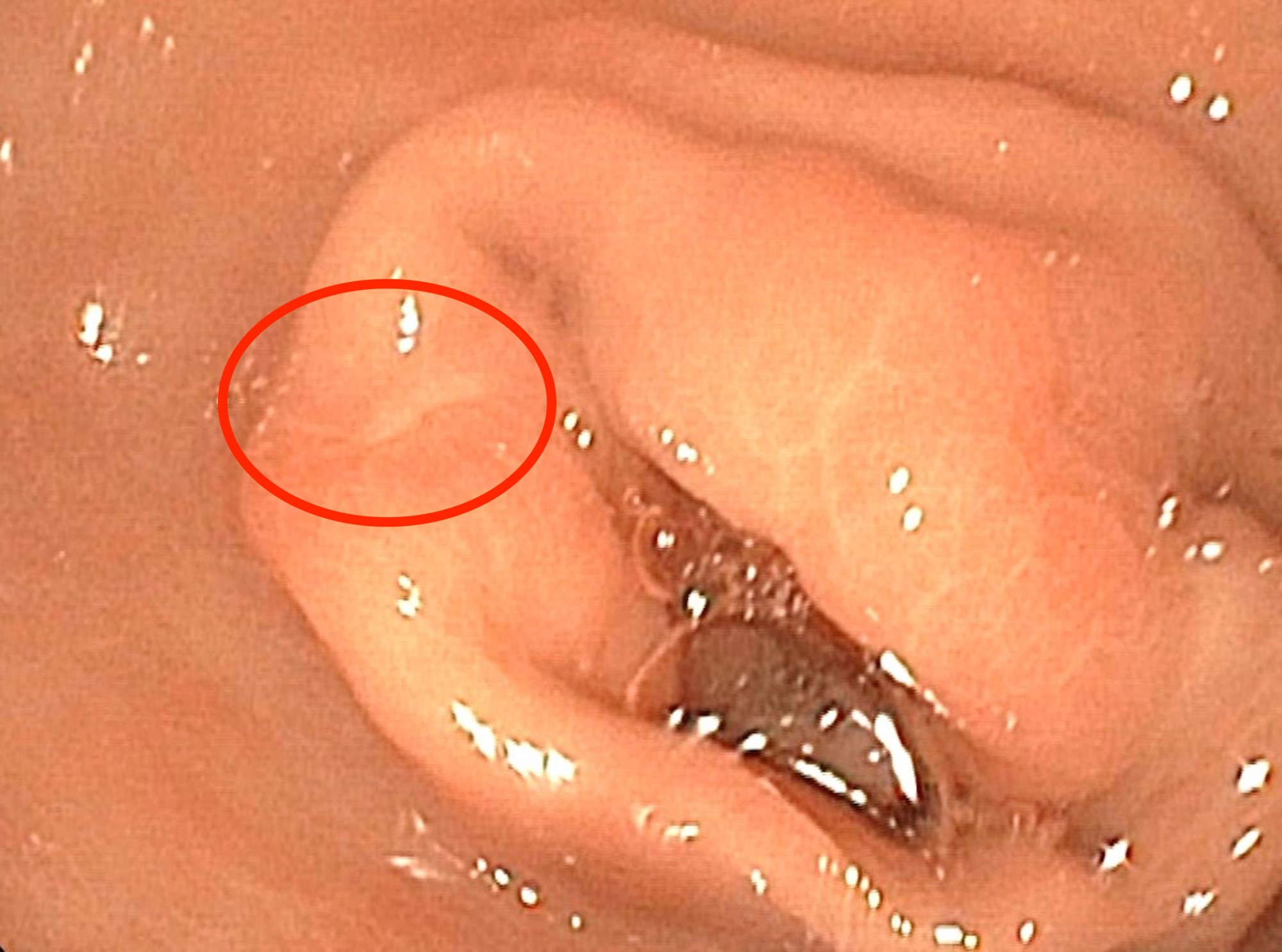 Endoscopy, subtle ectopic pancreas