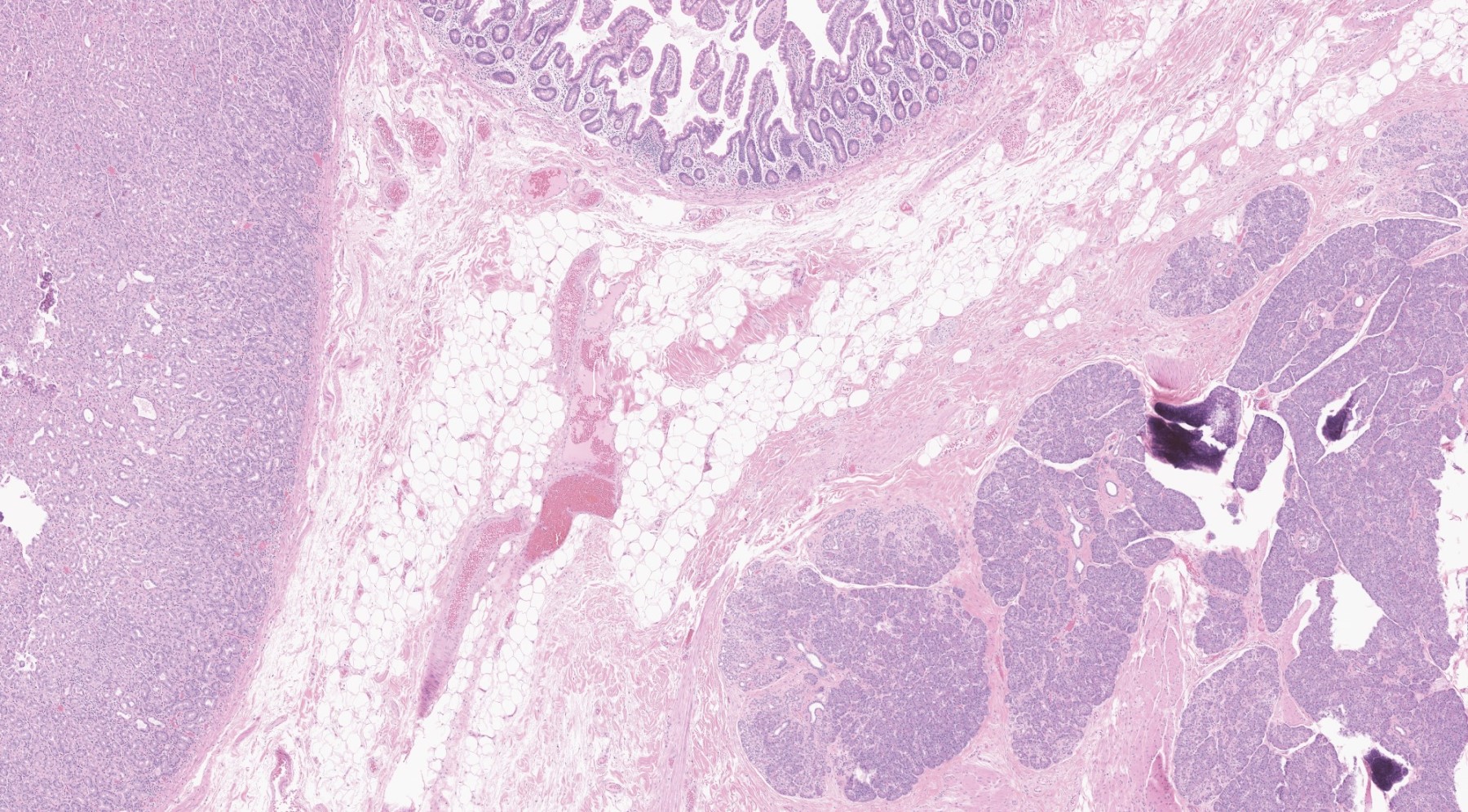 Meckel diverticulum with heterotopia