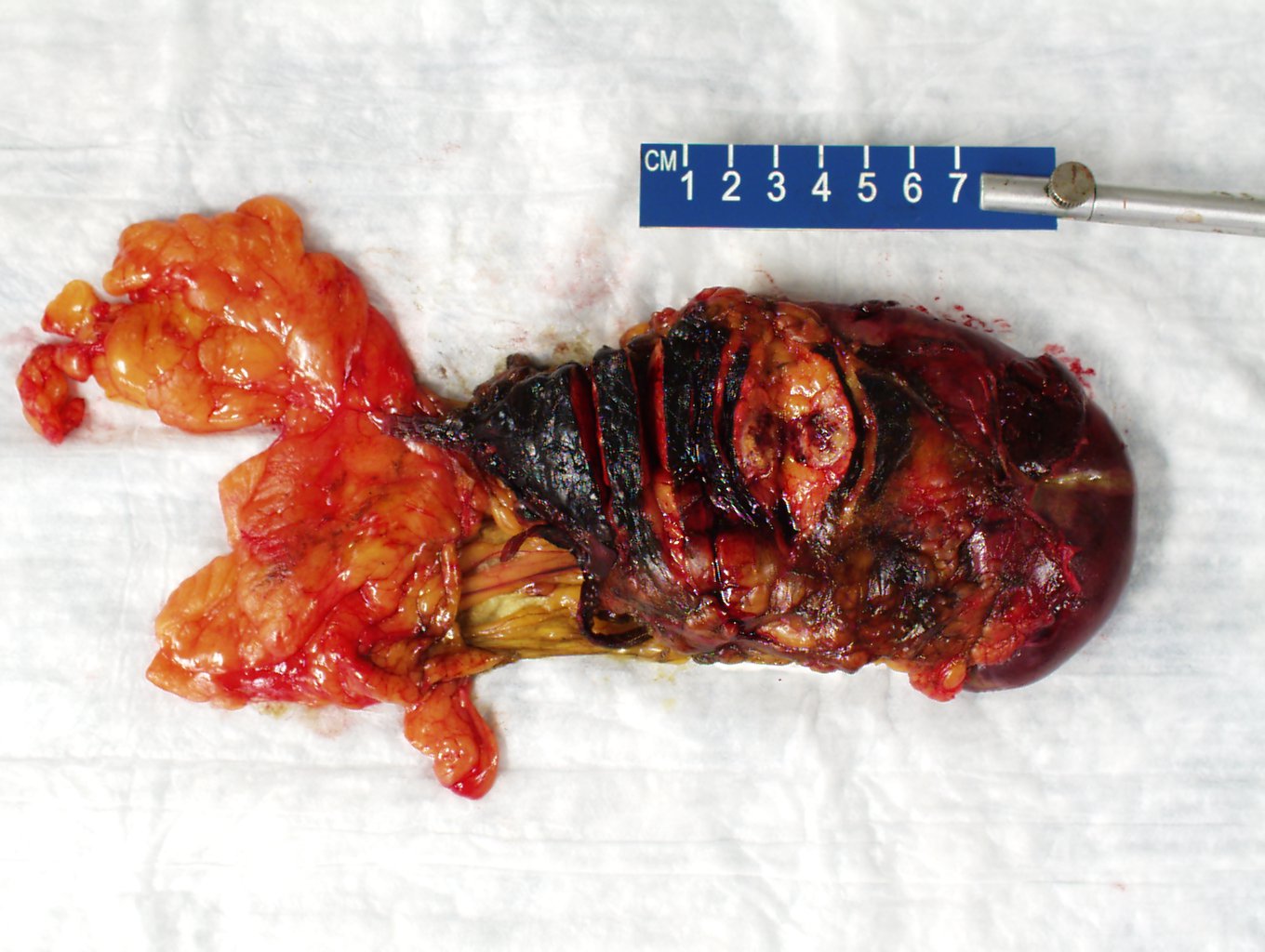 Pancreatic tail tumor