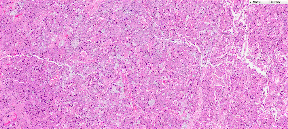 Intraductal oncocytic papillary neoplasm