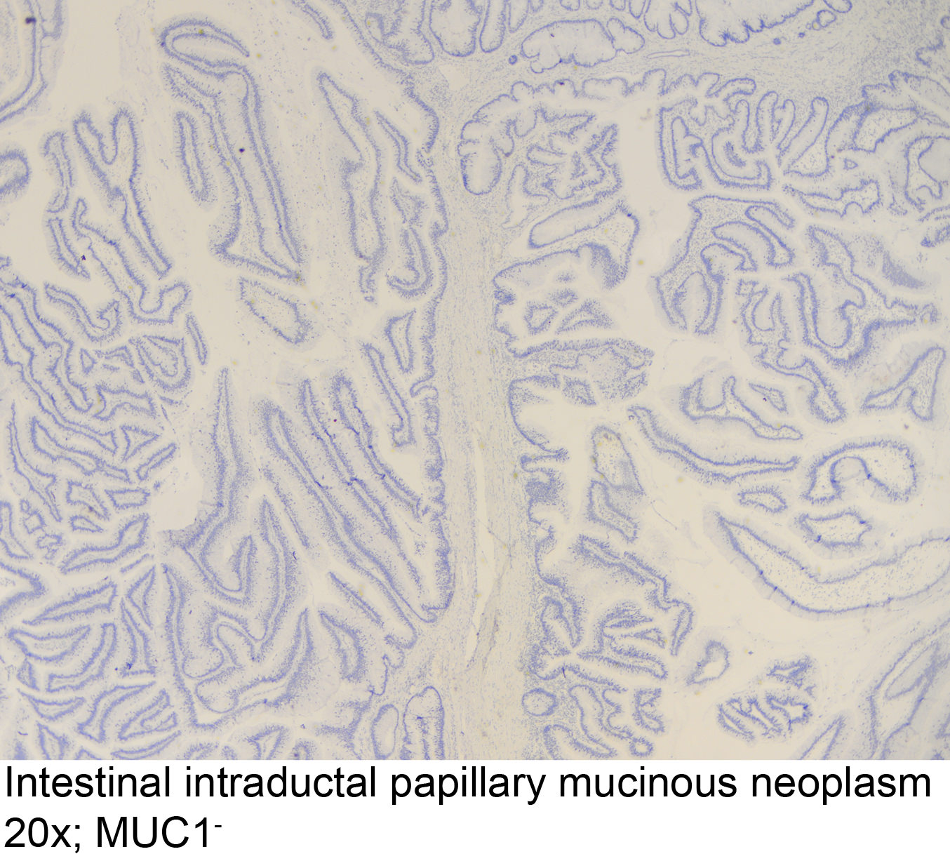 epeúti papillomatosis intraductalis papilláris mucinous neoplazma