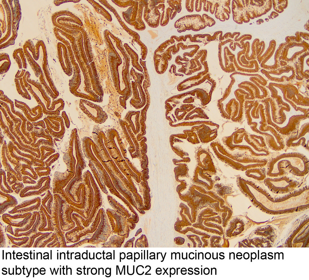 Epeúti papillomatosis intraductalis papilláris mucinous neoplazma, Much more than documents.