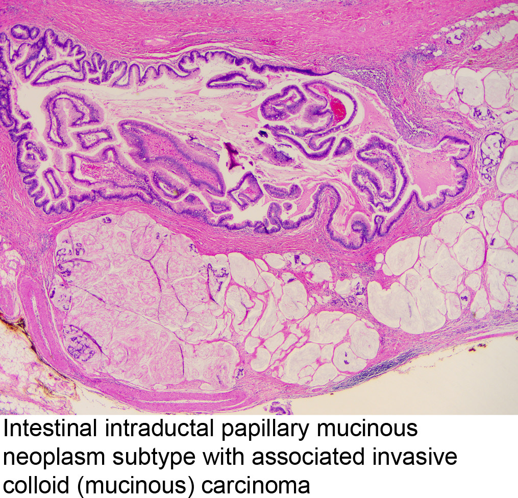 Epeúti papillomatosis intraductalis papilláris mucinous neoplazma