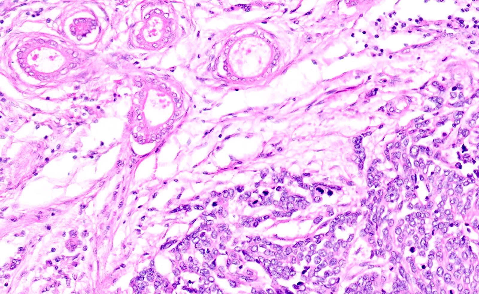 Mixed ductal neuroendocrine carcinoma