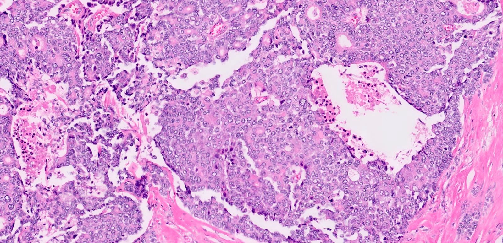 Neuroendocrine carcinoma component