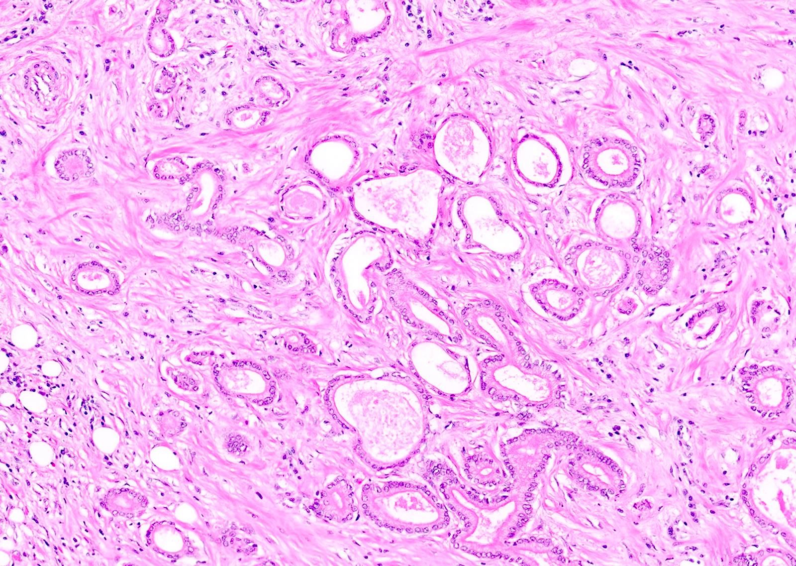 Ductal adenocarcinoma component