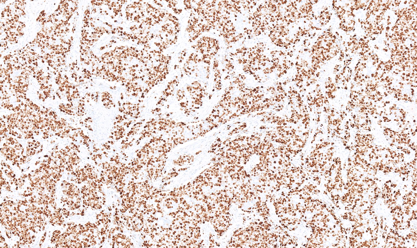  Ki67 neuroendocrine carcinoma component