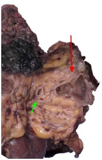 Multiloculated cyst in pancreatic head