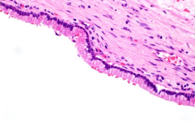 Gastric type mucinous epithelium