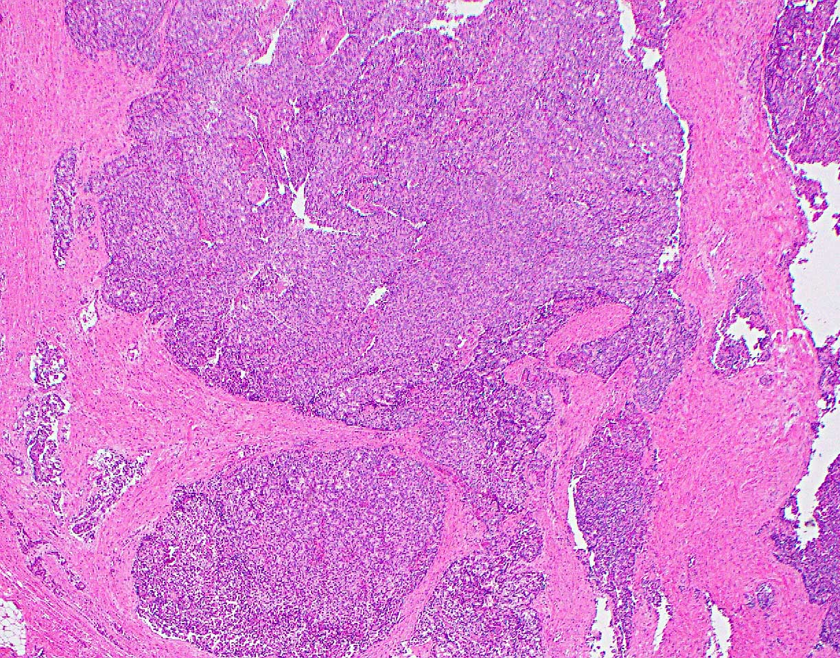 Lobulated tumor nests