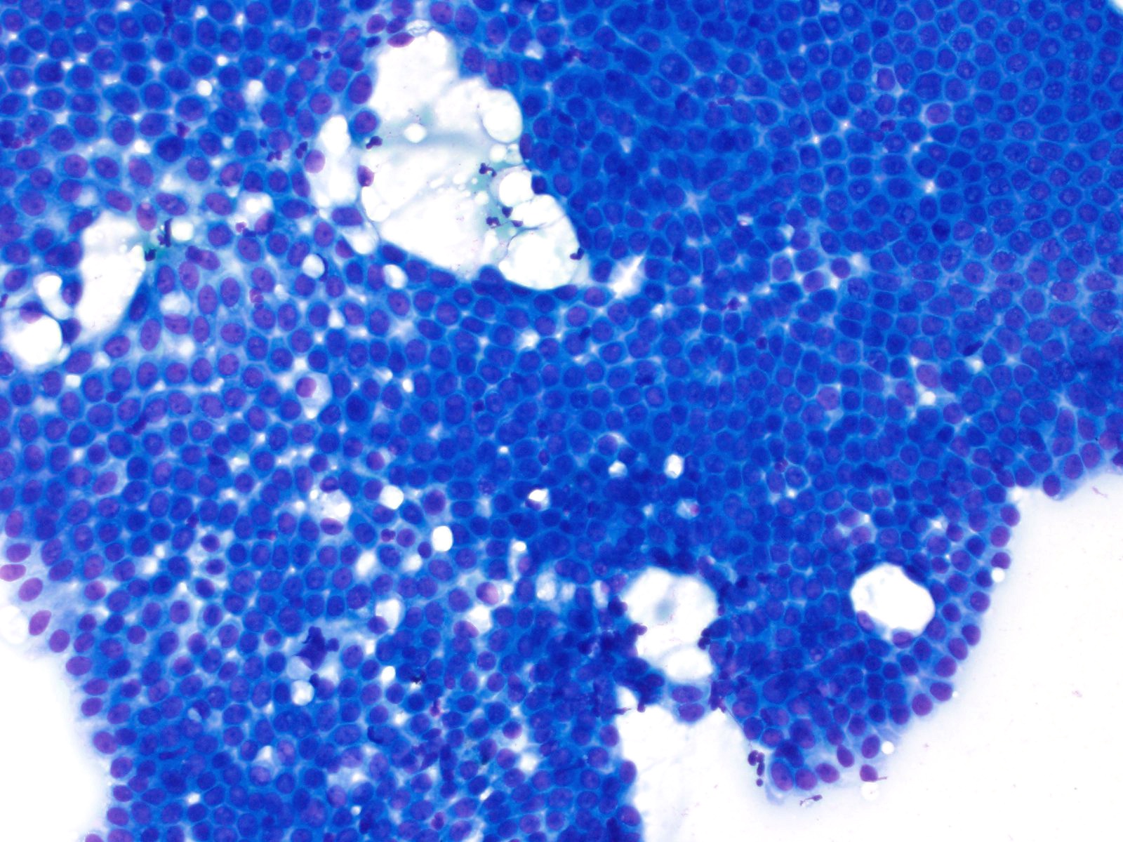 Cytopathological characteristics of solitary fibrous tumour involving the  pancreas by fine needle aspiration: Making an accurate preoperative  diagnosis in an uncommon location - Jones - 2022 - Cytopathology - Wiley  Online Library