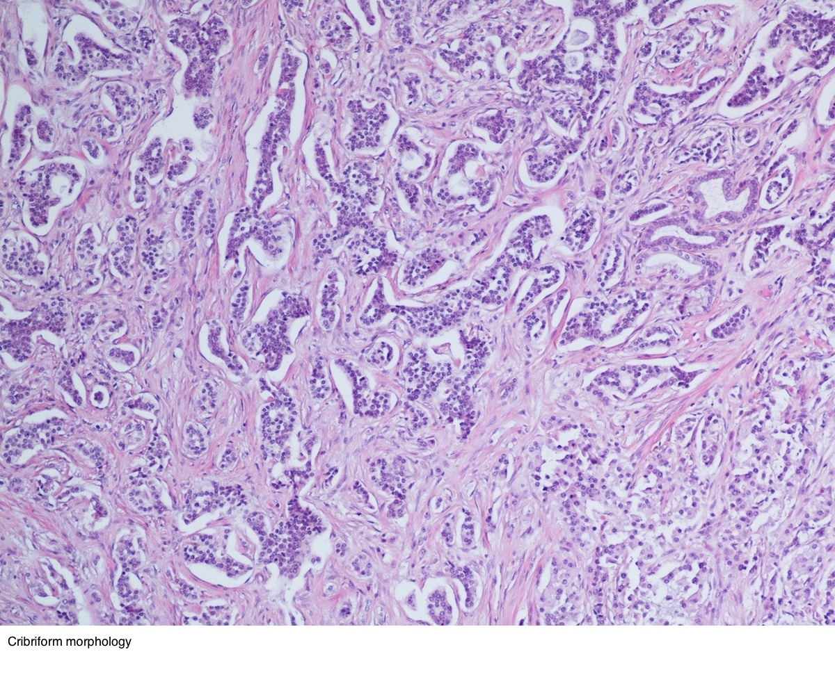 Neuroendocrine cancer pathology outlines - Gastric cancer pathology
