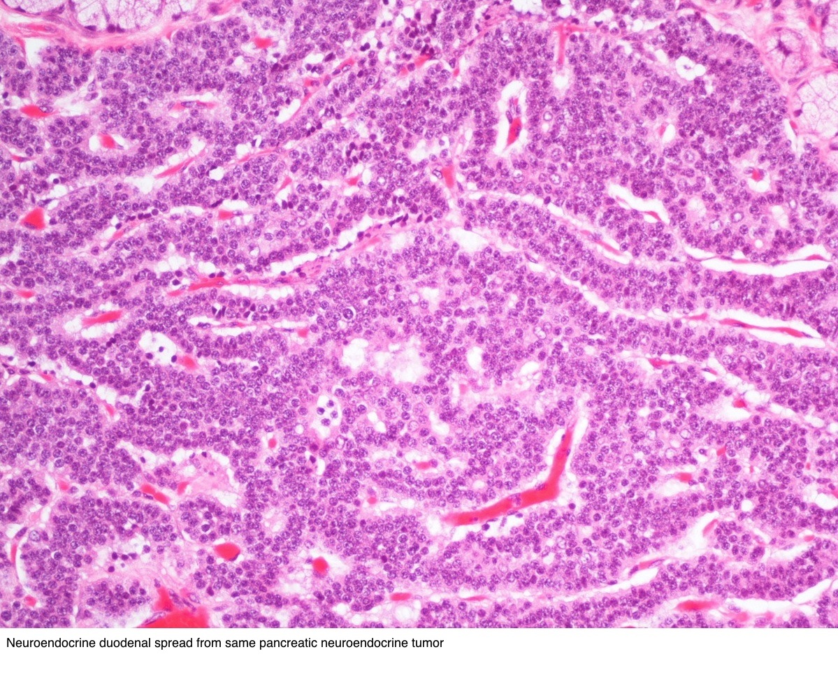 adenocarcinoma with neuroendocrine differentiation pathology outlines Tavanik segített a prosztatitisben
