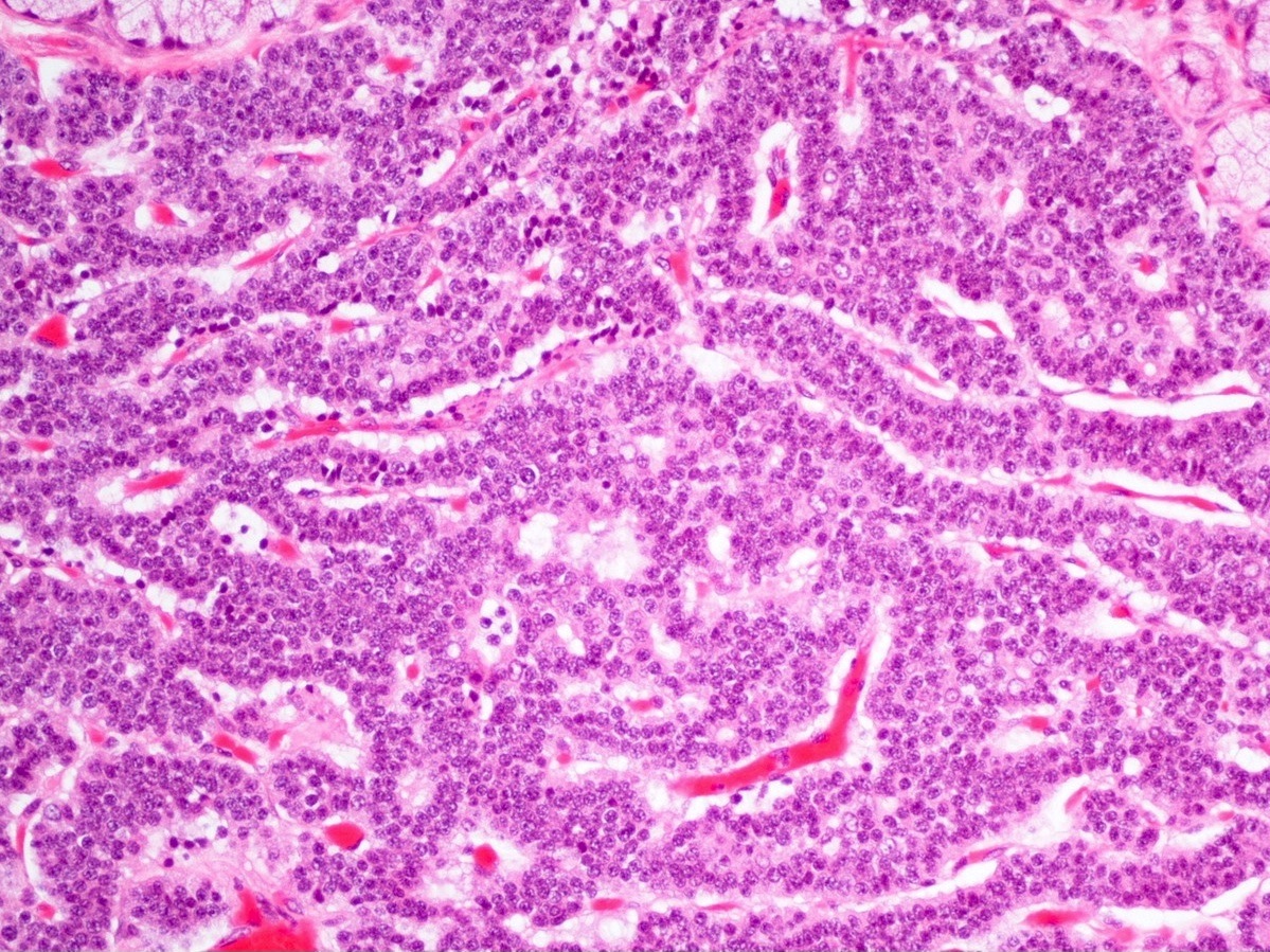 prostate neuroendocrine carcinoma pathology outlines