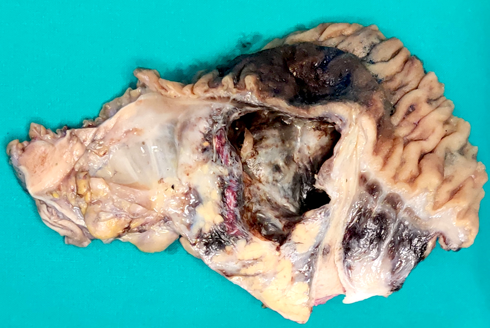 Large pseudocyst of the pancreatic head