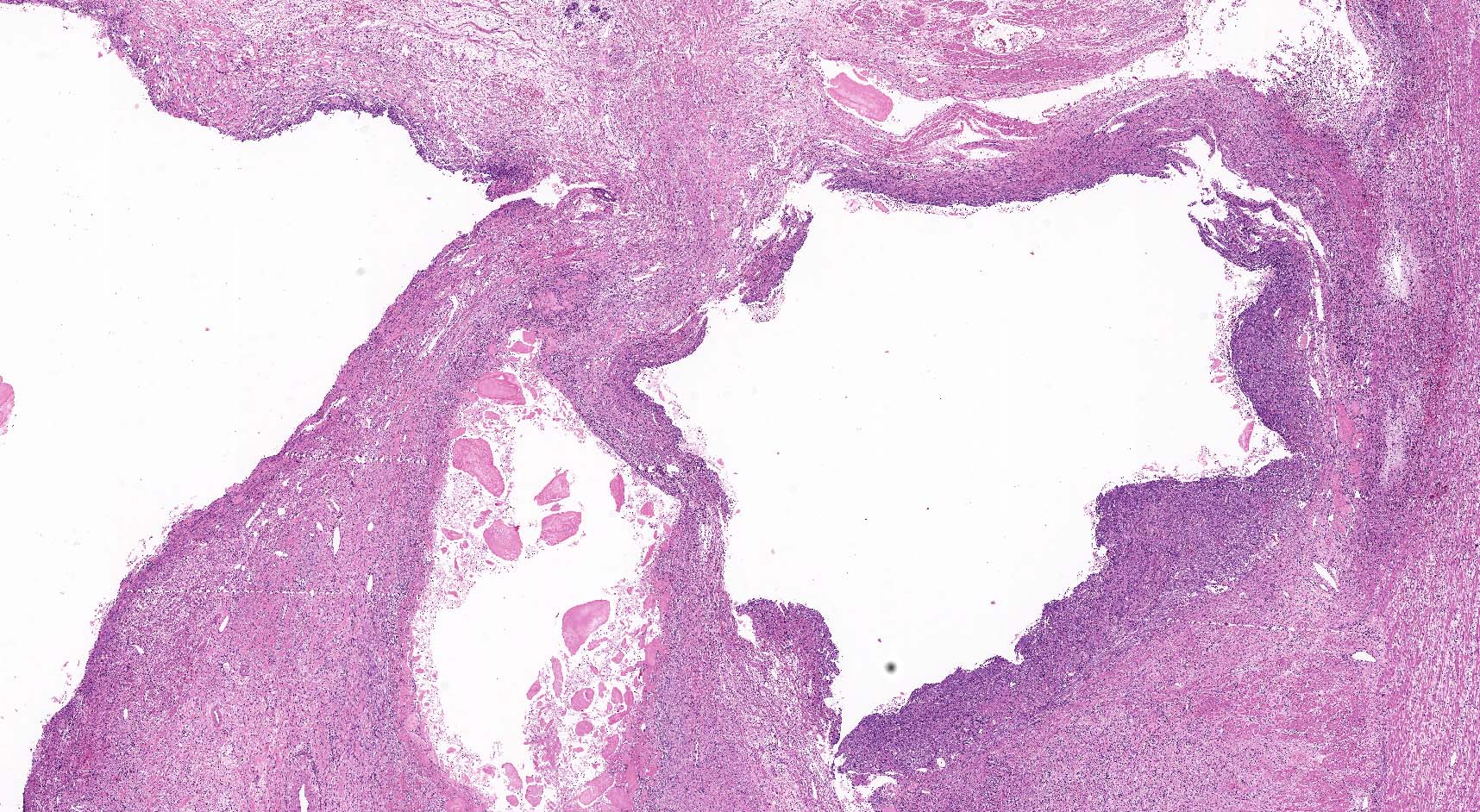 Inflammation of pseudocyst wall