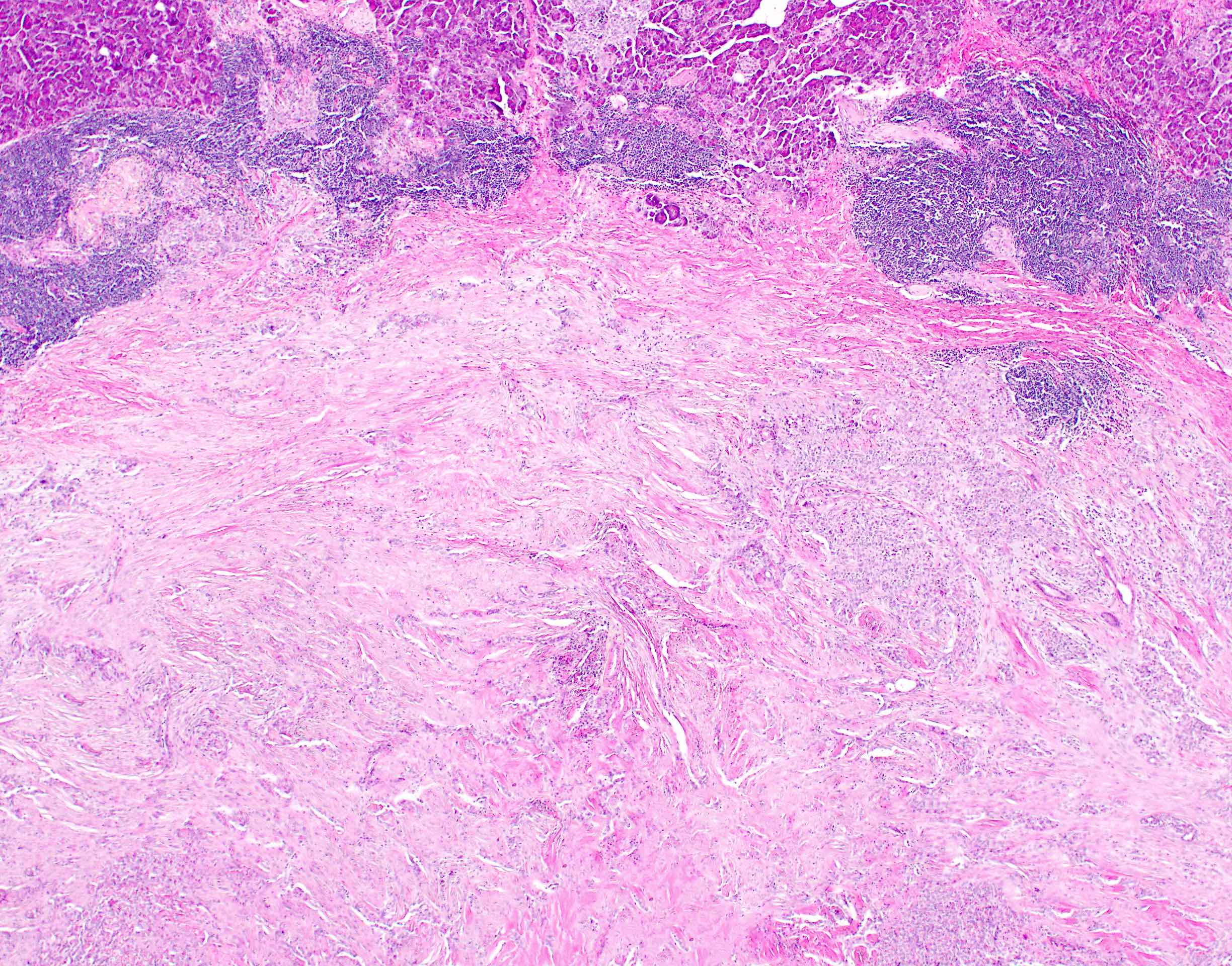 Peripheral dense lymphoid aggregates