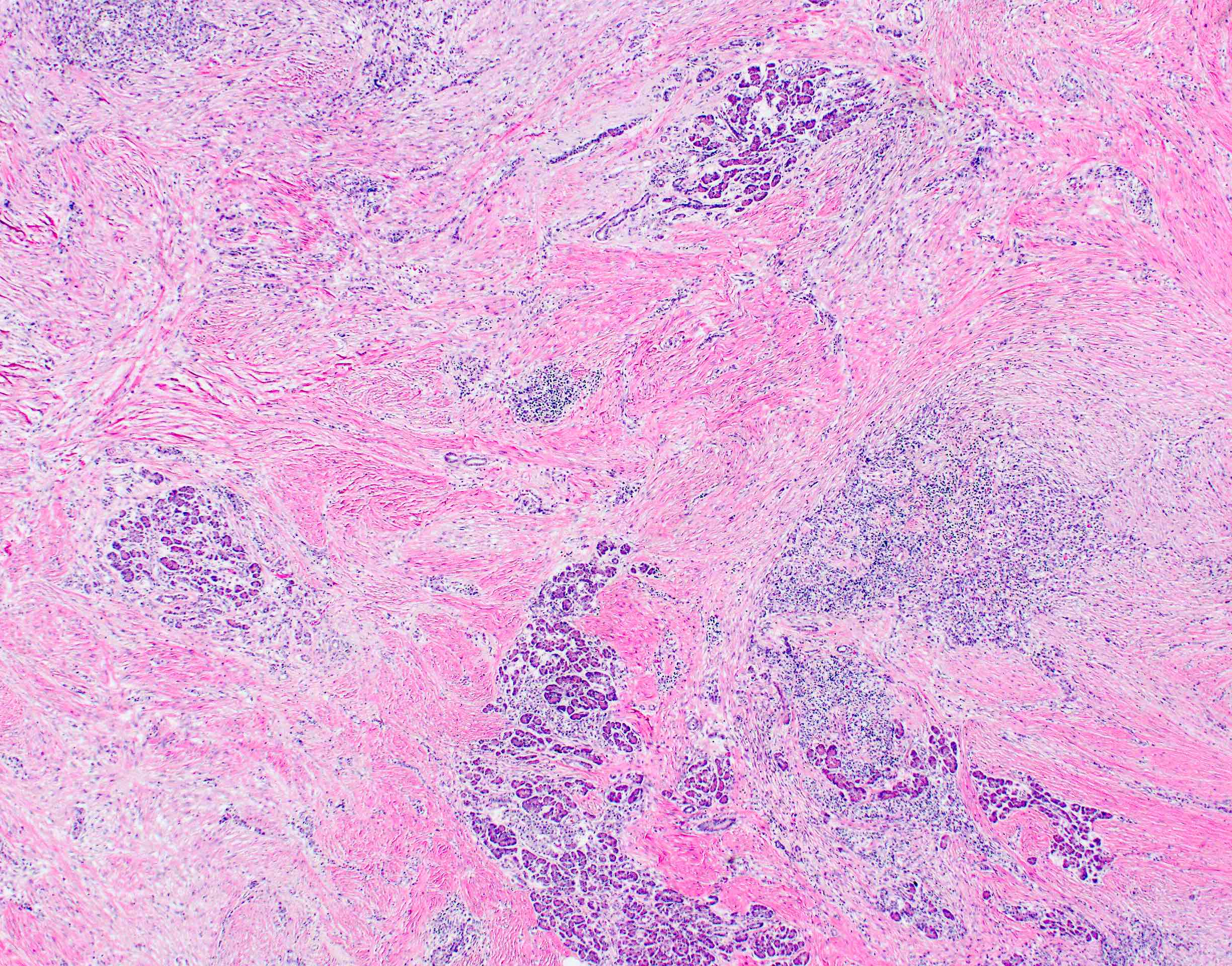 Entrapped pancreatic parenchyma