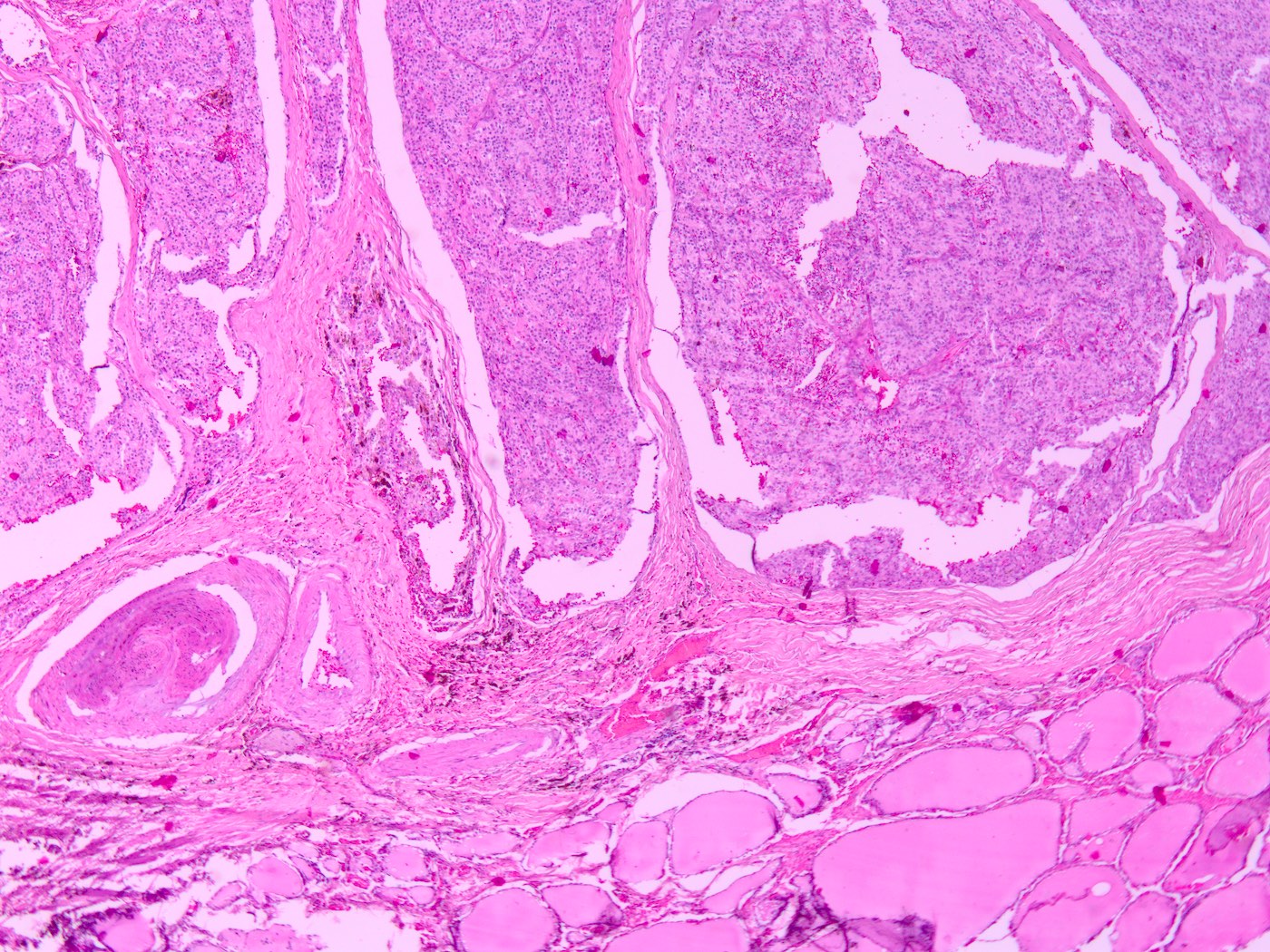 Atypical adenoma and thyroid