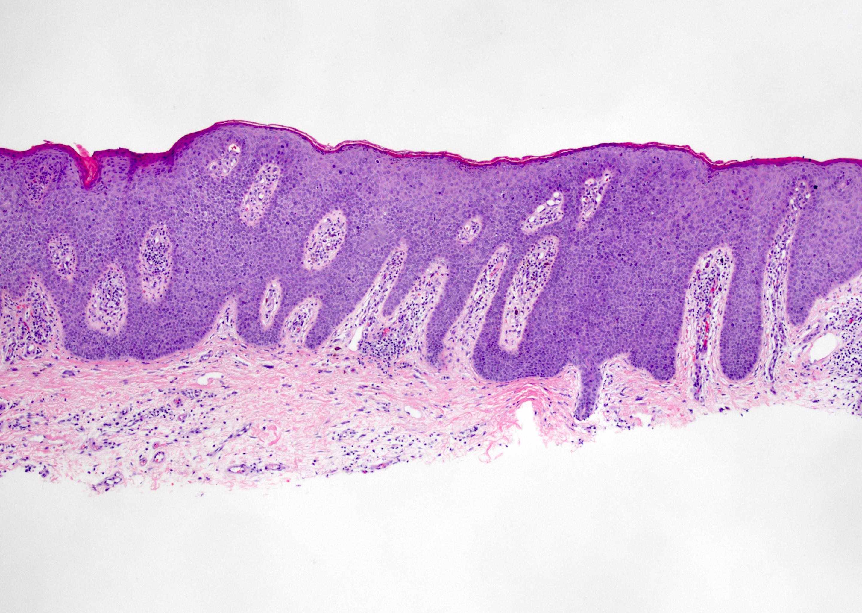 Pathology Outlines - Bowenoid papulosis