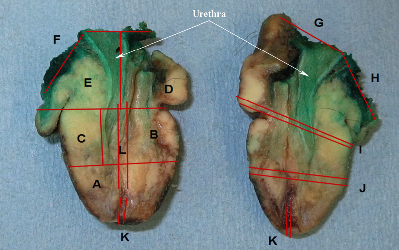 Mapped partial penectomy specimen
