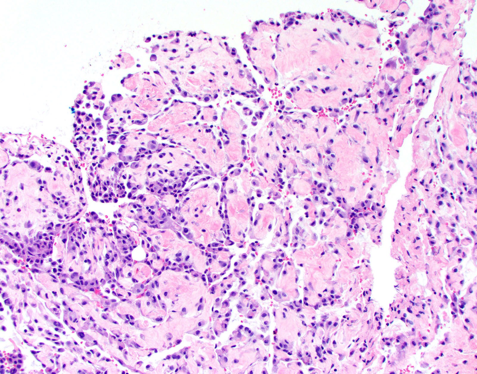 Fibrosis of papillary cores