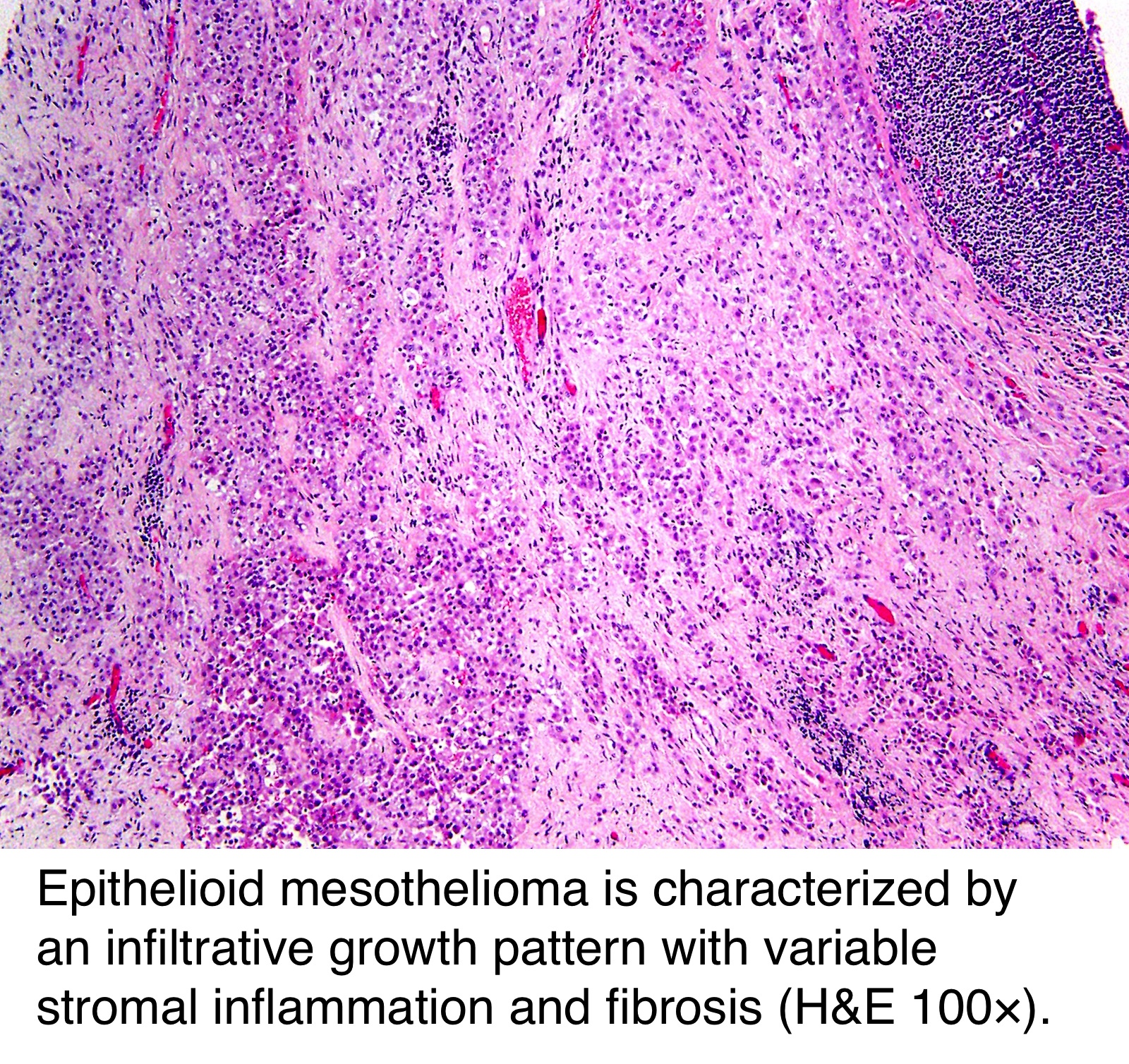 can breast cancer cause fatty liver disease