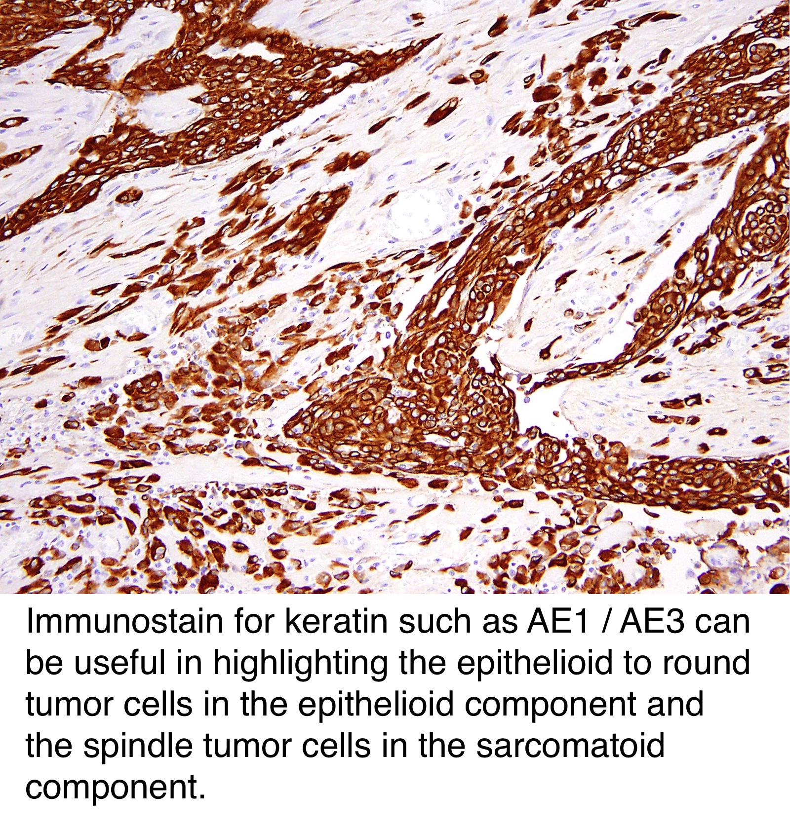 malignant pleural effusion caused by lymphoma