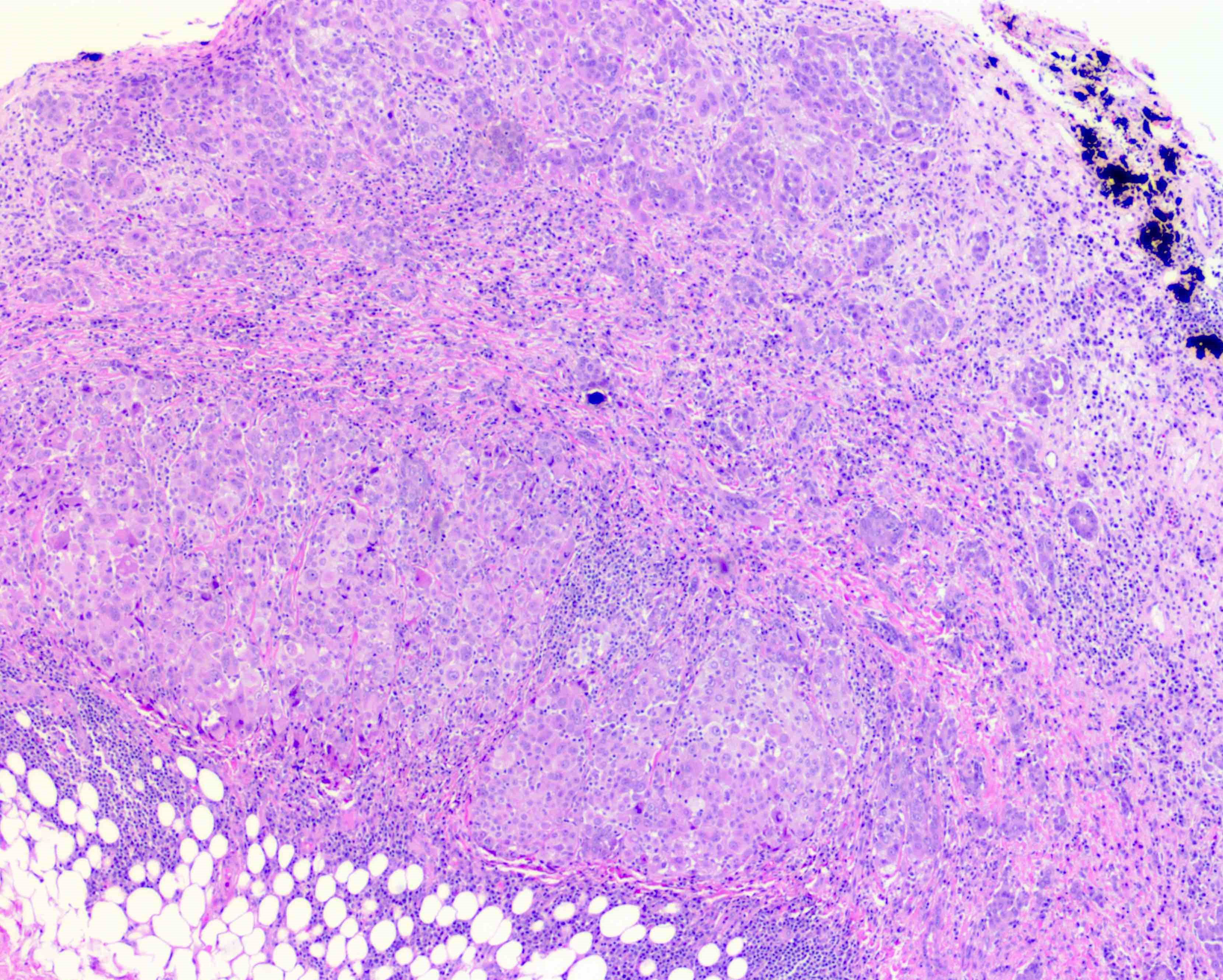 Pathology Outlines Mesothelioma Peritoneum Epithelioid