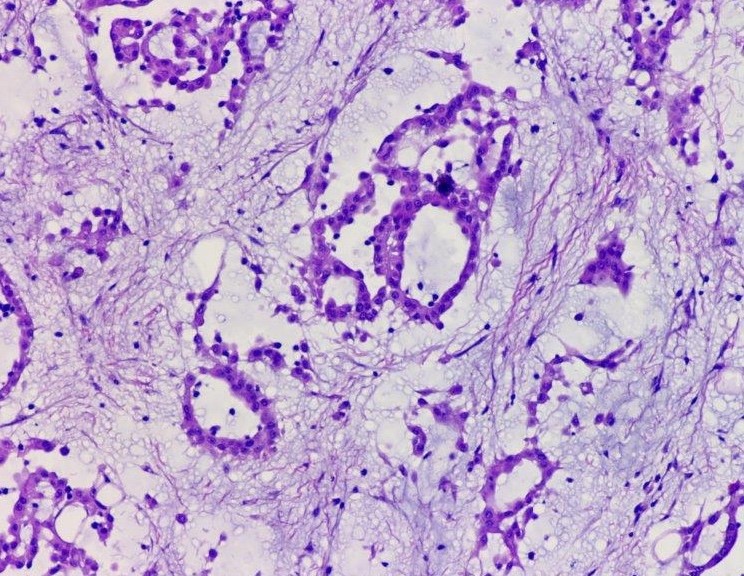 Myxoid variant of peritoneal mesothelioma