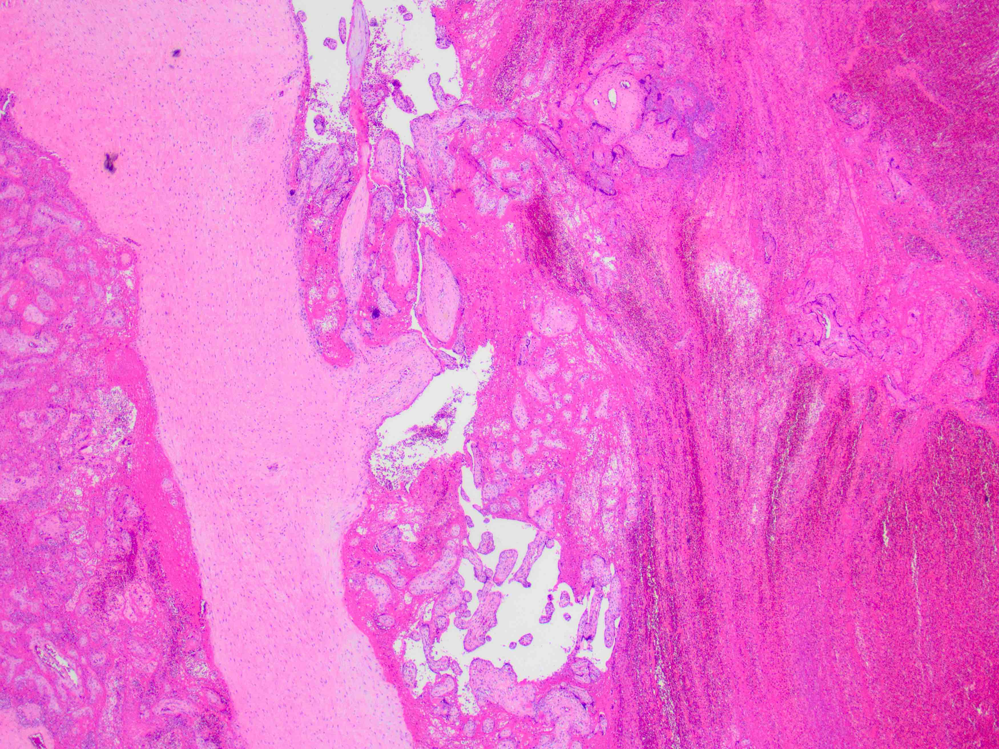 Perivillous fibrin deposition and intervillous thrombus