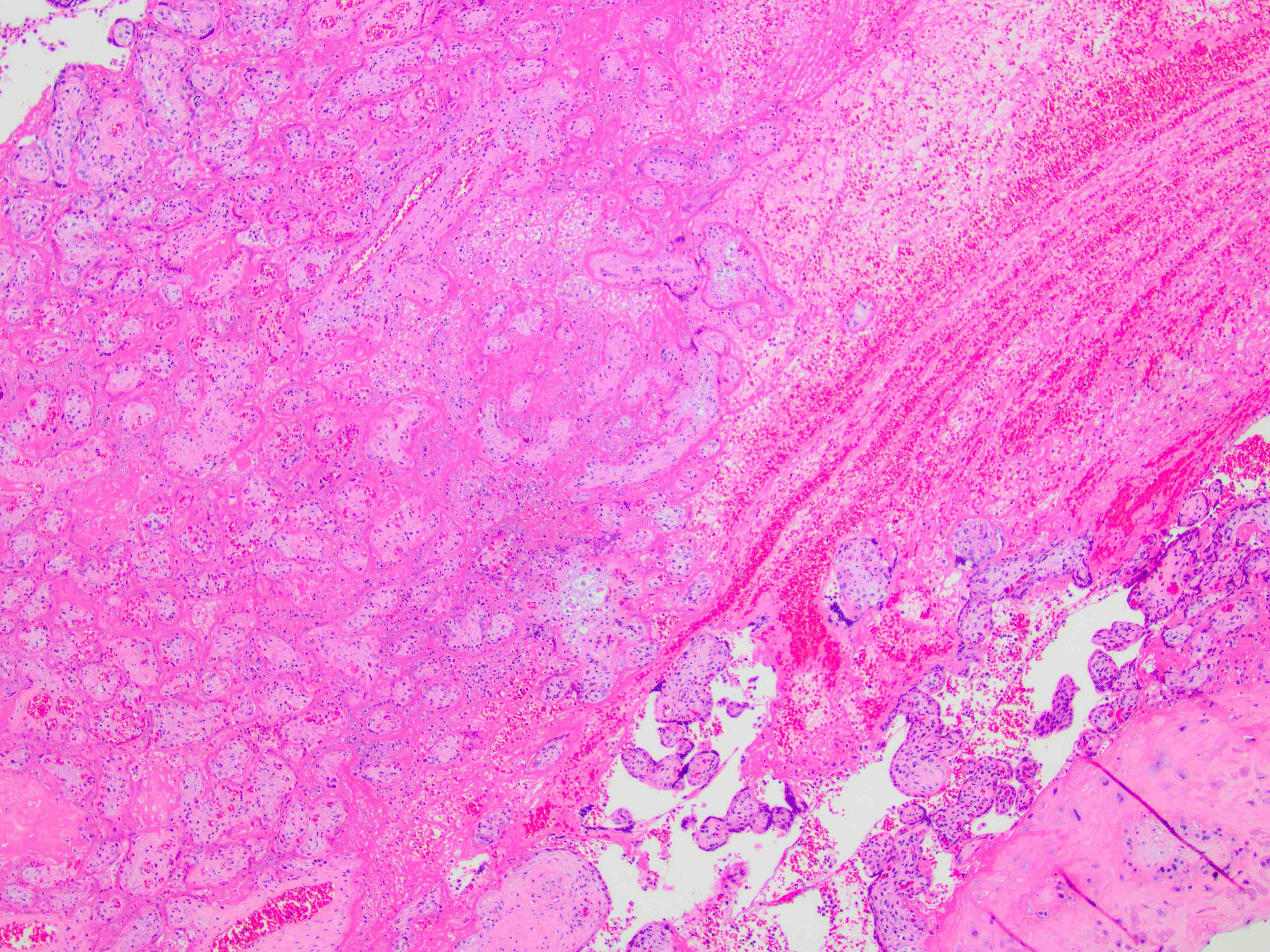 Perivillous fibrin deposition and trophoblast necrosis