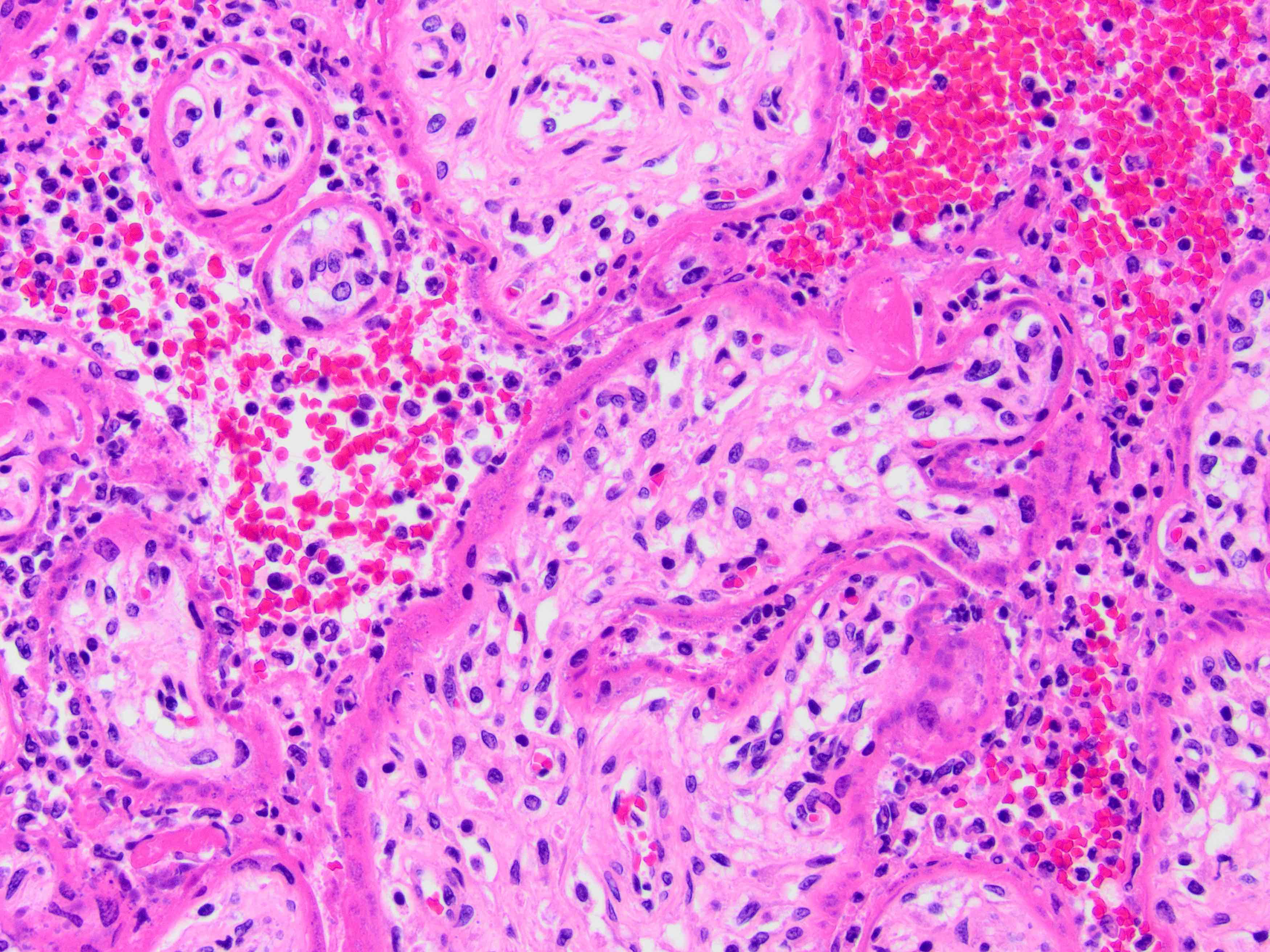 Chronic intervillositis and trophoblast necrosis