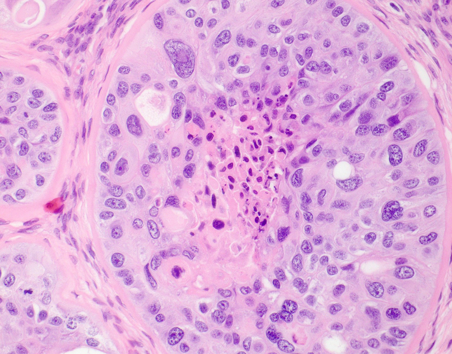 Epithelioid tumor cells