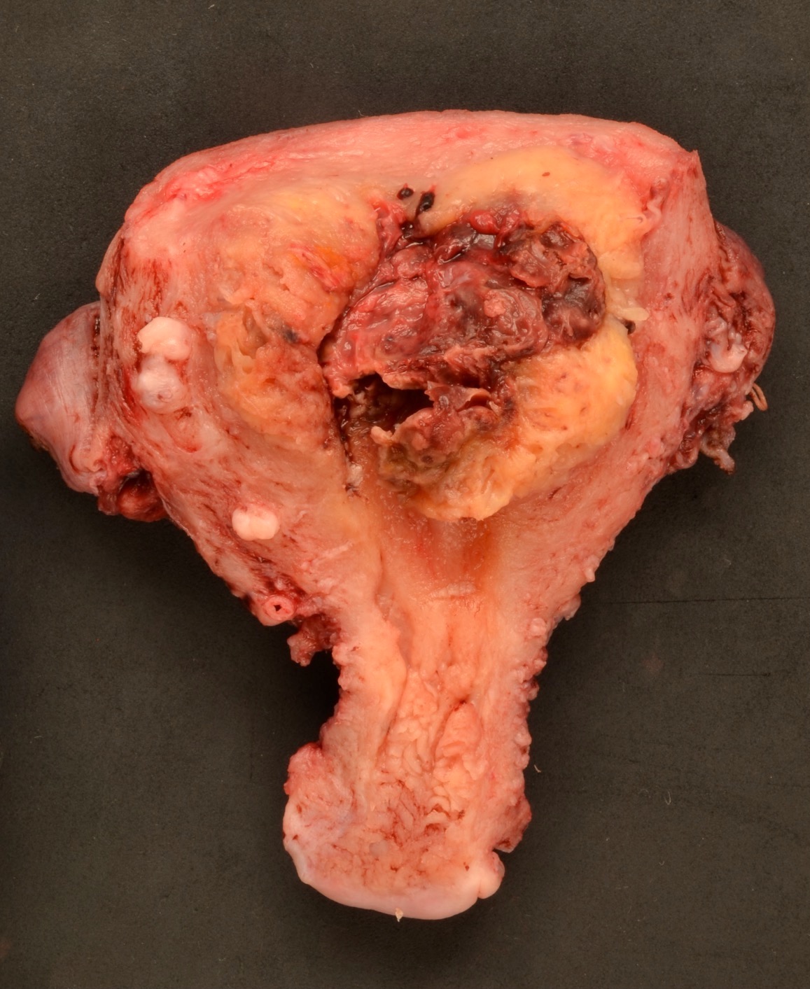 Anterior endomyometrium with exophytic mass