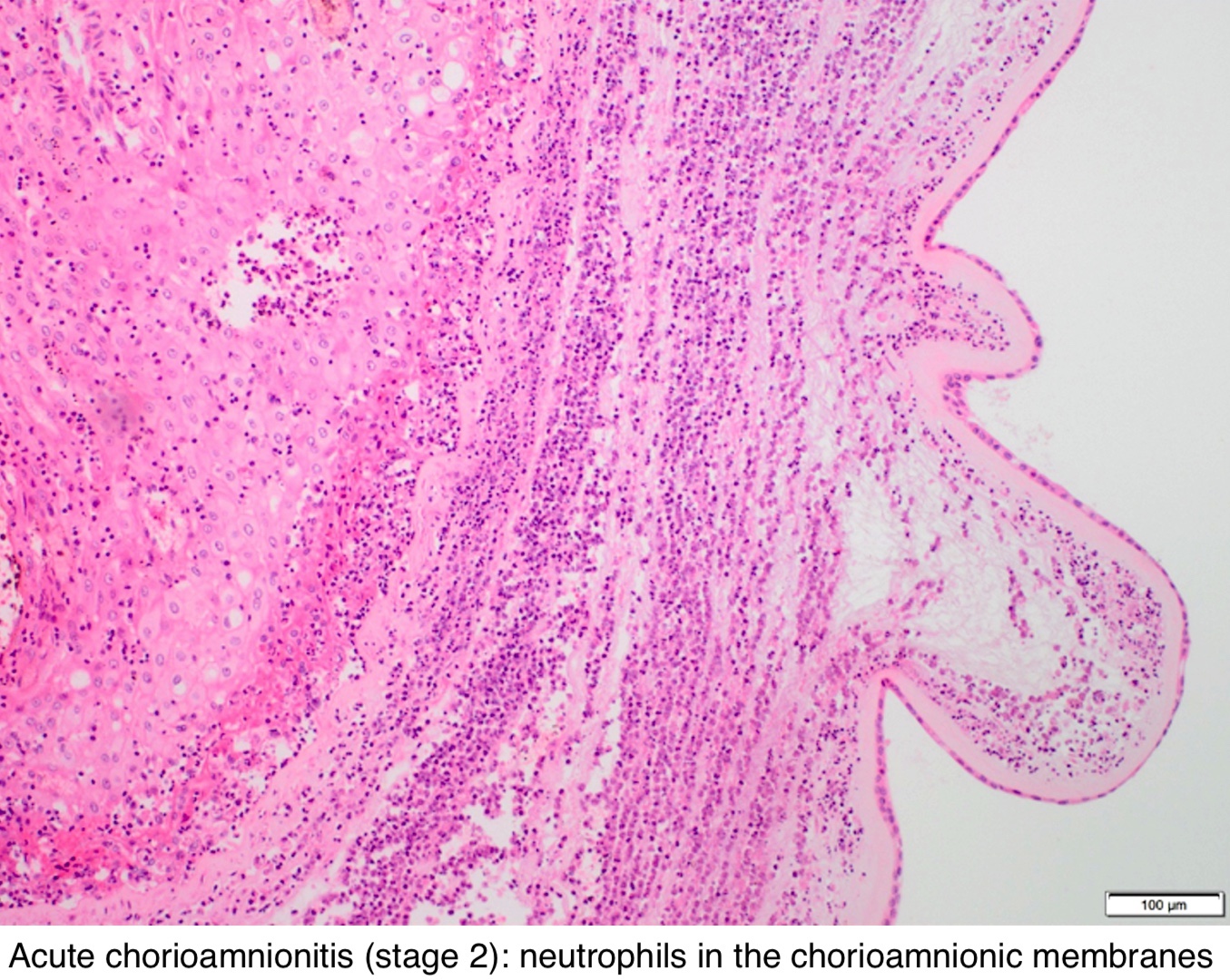 Pathology Outlines - Acute chorioamnionitis