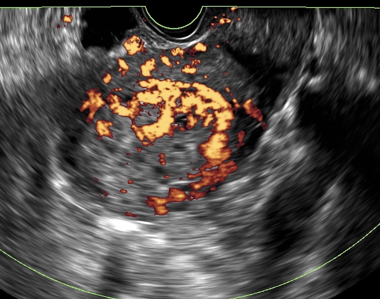 Ultrasound of uterine choriocarcinoma