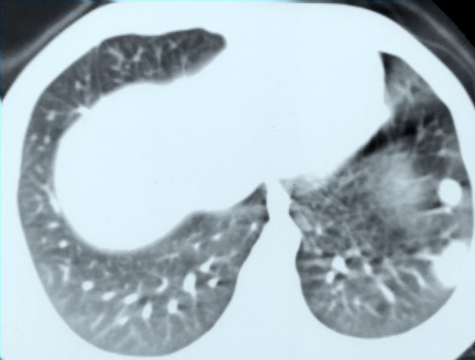 CT scan with lung metastases