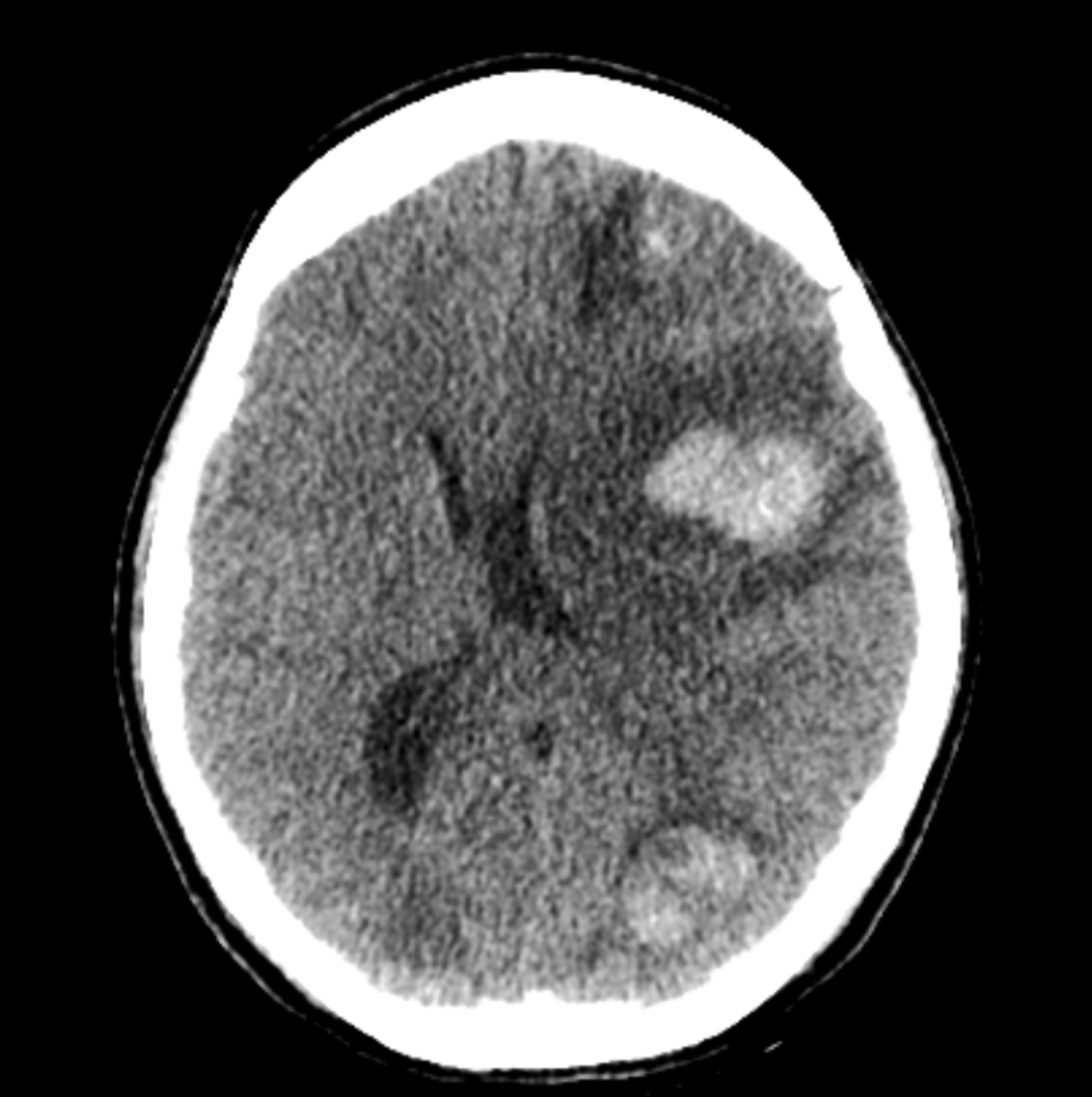 CT scan with brain metastases
