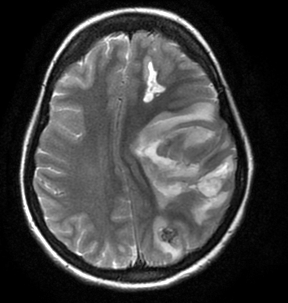 MRI scan with brain metastases