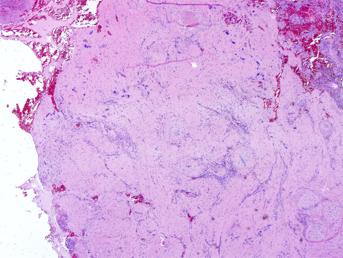 Intermediate trophoblasts invading myometrium