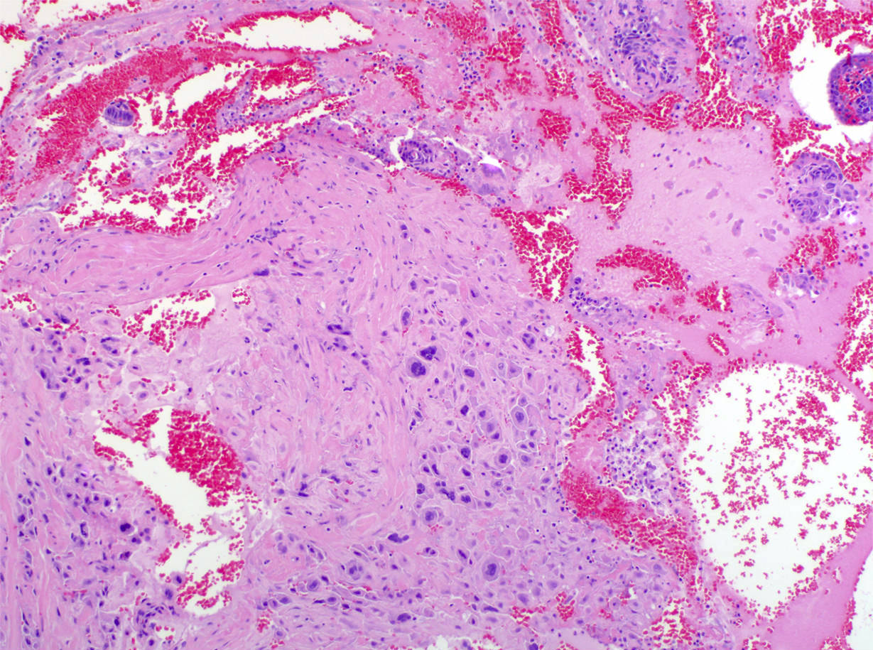 Intermediate trophoblasts invading myometrium